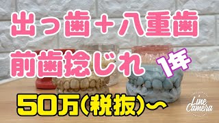 304)出っ歯＋八重歯＋前歯捻じれを白いワイヤー矯正で1年　費用45-50万円(税抜)マウスピース矯正適応外の症例