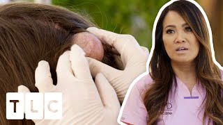 Dr Lee Shocked By Patient Removing A Cyst From His Own Head! | Dr Pimple Popper: This Is Zit