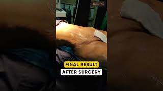Weight Loss After 360° Abdomen liposuction result #shorts
