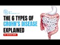 THE DIFFERENT TYPES OF CROHN'S DISEASE I DID YOU KNOW ABOUT THESE? I THE GRUMBLING GUT