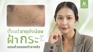 รักษาฝ้า I EP.10 HOW TO แก้ไขฝ้ากระ ที่เกิดขึ้นอายุยังน้อย  l The Vive Clinic