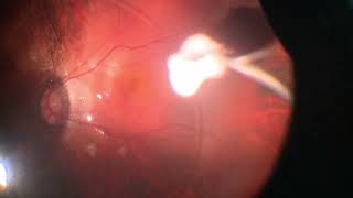 Vitrectomy for Myopic Macular hole  with posterior pole detachment| Macular hole | Dr Manish Nagpal