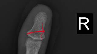 Thumb Fracture (Xray 39)