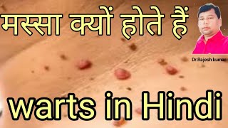 मस्सा क्यों होते हैं। मस्सा कितने प्रकार के होते है। मस्सा का क्या इलाज है। warts ky h। warts remov