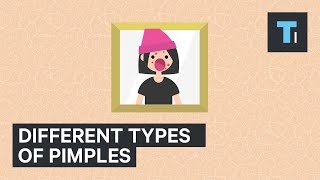 Different Types Of Pimples And How To Treat Them