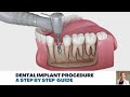 Dental Implant Procedure: A Step by Step Guide