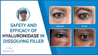 How Safe and Effective is Hyaluronidase in Dissolving Fillers?