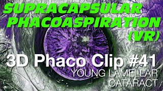 3D Phaco Clip #41 - Young Lamellar Cataract (VR Headset version)