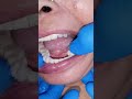 Dental Crowns And  Lower Complete Teeth