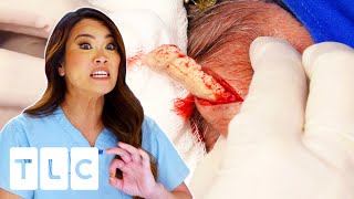 Dr. Lee Removes Golf Ball Sized Cyst From Patients Head | Dr Pimple Popper: This Is Zit l UNCENSORED