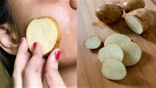 i rub Potato on my face & it removed my Dark spots and hyperpigmentation in 30 days