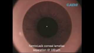 Bladeless Lasik Surgery – Femto Lasik Surgery performed by Dr Vandana Jain at AEHI, Mumbai, India