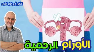 الاورام الليفية الرحمية  -  الدكتور كريم العابد العلوي  -