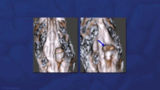 Suboccipital Telovelar Approach for Resection of a Dorsal Pontine Cavernous Malformation