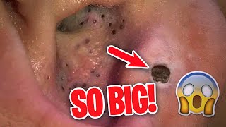 The BIGGEST removals EVER seen on Dr. Pimple Popper (PART 2)