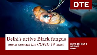 Delhi's active Black fungus cases exceeds the COVID-19 cases