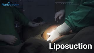 Liposuction | Male breast reduction | পুরোপুরি অজ্ঞান করে গাইনাকোম্যাস্টিয়া সার্জারি | Gynecomastia