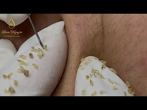 loan nguyen acne treatment blackheads - FunClipTV