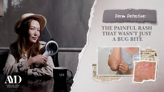 Derm Detective: The Painful Rash That Wasn’t Just a Bug Bite