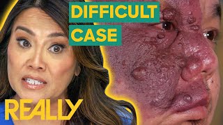 Dr. Lee Calls For Backup To Tackle An Extreme Case | Dr. Pimple Popper