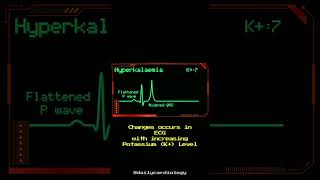 Hyperkalemia | ECG changes #shorts #cardiology #ecg #hyperkalemia #potassium