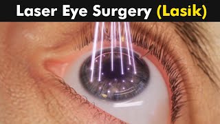 How Laser Eye Surgery (Lasik) is Performed? | 3D Animation (Urdu/Hindi)