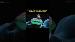 clinical features and surgical method of hemorrhoids #short # animation