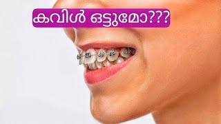 കവിൾ ഒട്ടുമോ / braces / pallil kambi idunnath malayalam / pallil kambi / kambi / face braces