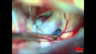 SUPRABROW Craniotomy for PcomA aneurysm