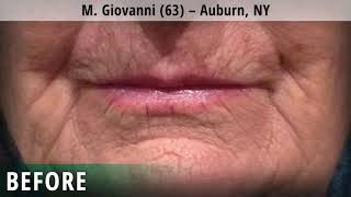 Angellift 30 day Results