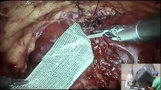 BioD Mesh During Robotic Prostatectomy (RALP)_1 min.mp4