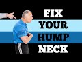 Single Best Fix (6 Min) for Neck Hump (Buffalo Hump)