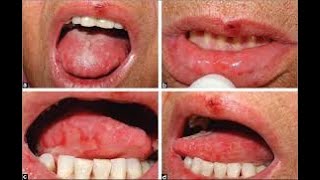 Measuring Tolerance Dose of the #Methotrexate for Induction of Oral #Mucositis in Dark a #Gourti Rat