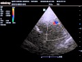 transcranial doppler study of the RT internal carotid.