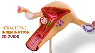 Intrauterine Insemination (IUI) for Pregnancy | Step by Step Guide | 3D Animation