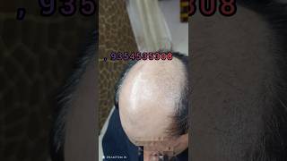 no side effects hair patch #shorts #viral #youtubeshorts
