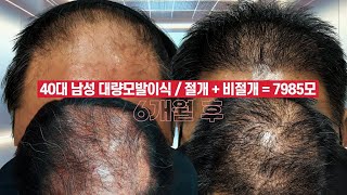 대량모발이식 혼용 절개 + 비절개 하루에 7985모이식 6개월 전  후