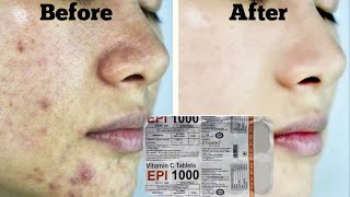 Epi Tablets for Skin Whitening | Health | Clear and Glowing skin | Brijwasi Girl | Spotless skin