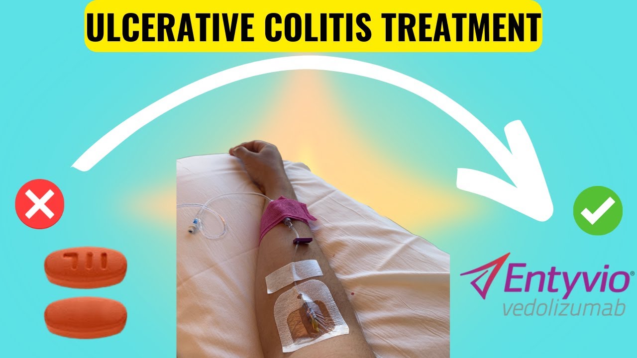 My Journey With Ulcerative Colitis: How Biologics Changed Everything ...