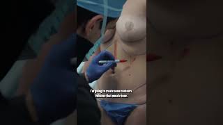 Pre-operative drawings before fat removal with liposuction. Do you guys want to see more?