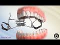 Effective Techniques for Turning Expanders in Interceptive Orthodontics