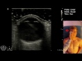 ocular ultrasound basics made simple