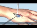 transverse fracture of 4th metacarpal 4th metacarpal fracture 3danimation animation