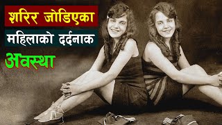 यी बालिका जो सानै उमेरमा बेचिएकी थिईन | Two Conjoined Sisters Daisy and Violet Hilton