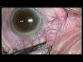 XEN Gel Stent Implantation  – Microinvasive Glaucoma Surgery (MIGS)