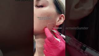 Masseter Botox | Facial Plastic Surgeon in Beverly Hills, CA #shorts
