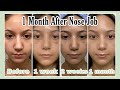 1 Month Rhinoplasty Update *With Pictures*