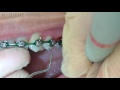 Hand Instrumentation Demonstration on Orthodontics