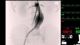 Mentice - Endovascular Aortic Repair