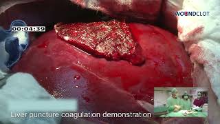 WoundClot Utilized To Control Bleeding From Liver Injury